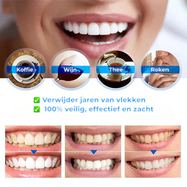 Tandenbleek stift – snelle, effectieve oplossing voor een wittere glimlach. Compact en gebruiksvriendelijk, ideaal voor onderweg. Verwijdert vlekken en zorgt voor een stralend resultaat.